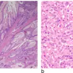 Familial Cancer Syndromes with Skin Manifestations