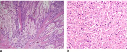 Familial Cancer Syndromes with Skin Manifestations