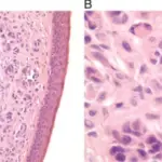 Familial Melanoma Syndrome