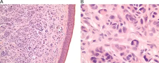 Familial Melanoma Syndrome