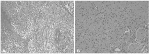 Familial Tumor Syndromes