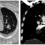 Fat Embolism