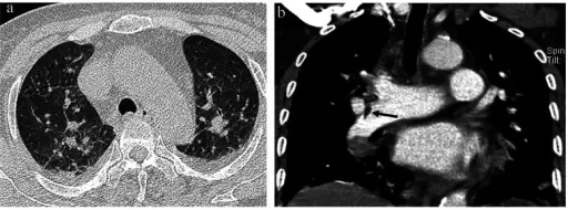 Fat Embolism