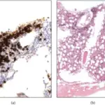 Features of Autoimmune Diseases