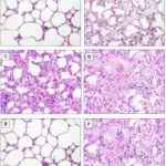 Febrile Non-hemolytic Transfusion Reaction