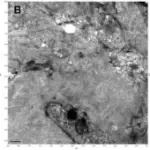 Fibrillary Glomerulonephritis