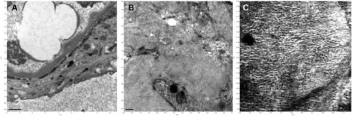 Fibrillary Glomerulonephritis