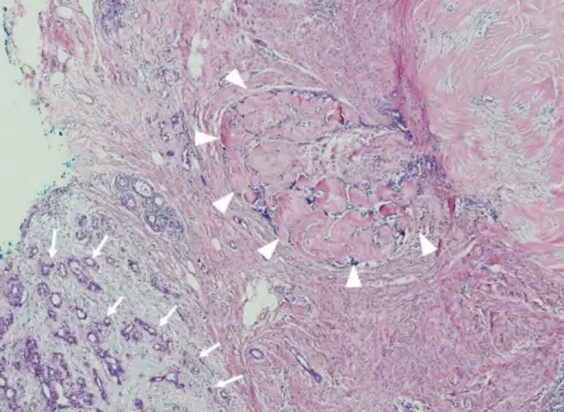 Fibroadenoma