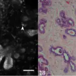 Fibrocystic Changes