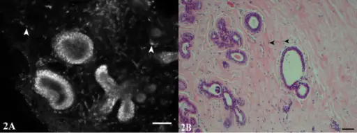 Fibrocystic Changes