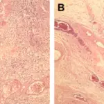 Fibroepithelial Polyp of the Ureter