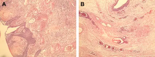 Fibroepithelial Polyp of the Ureter