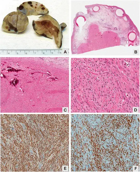 Fibromas