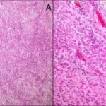 Fibromatosis