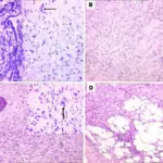 Fibromatosis