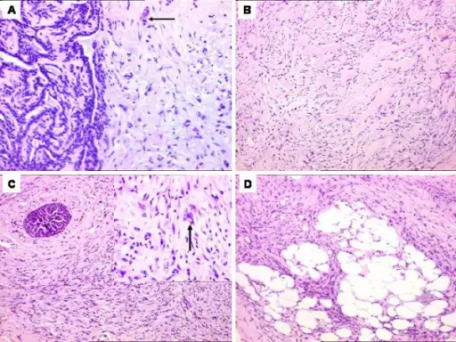 Fibromatosis