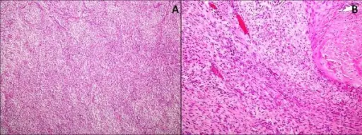 Fibromatosis