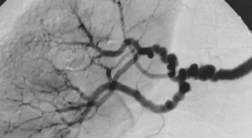 Fibromuscular Dysplasia