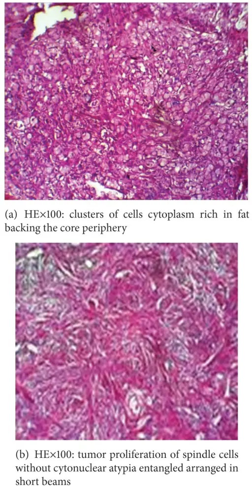 Fibrothecomas