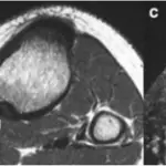 Fibrous Cortical Defects