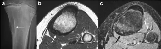 Fibrous Cortical Defects