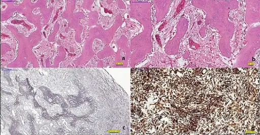 Fibrous Dysplasias