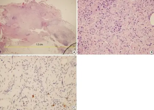 Fibrous Proliferative Lesions