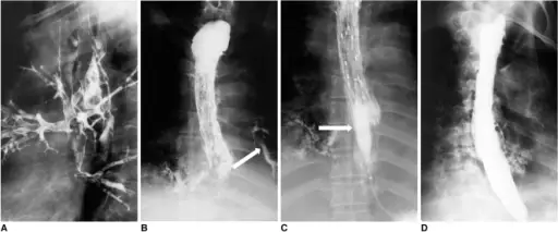 Fistulae