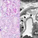 Focal Segmental Glomerulosclerosis