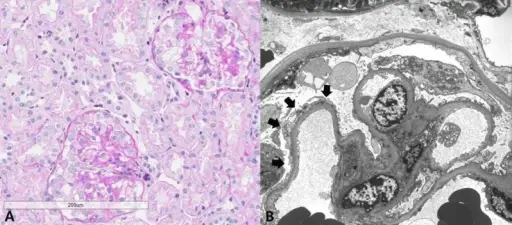 Focal Segmental Glomerulosclerosis