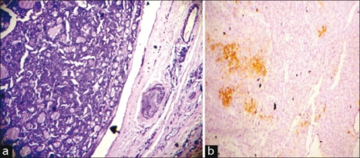 Follicular Adenomas