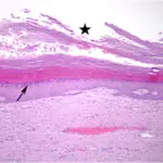 Follicular Inclusion Cyst