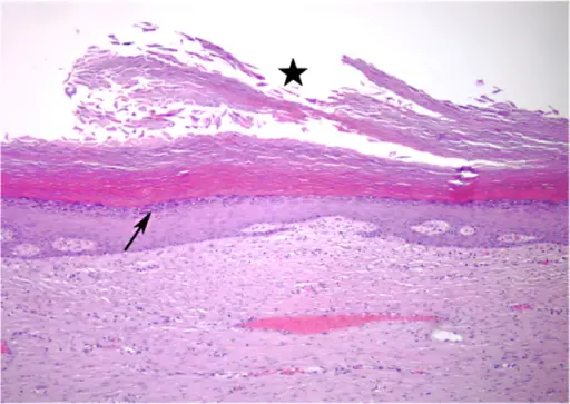 Follicular Inclusion Cyst