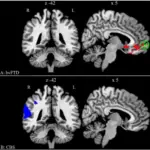 Frontotemporal Degeneration