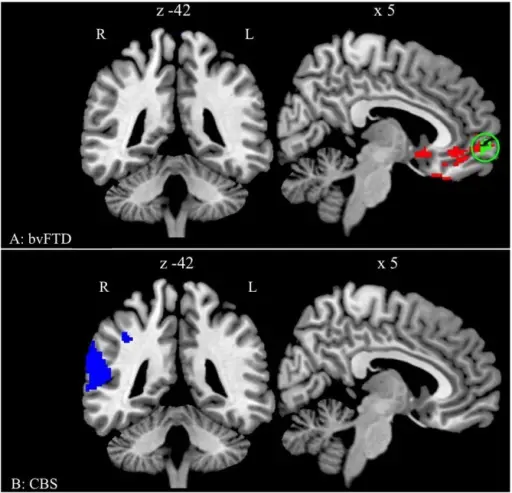 Frontotemporal Degeneration