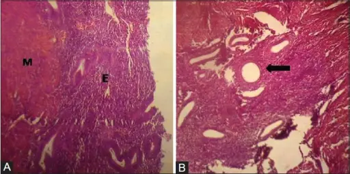 Functional Endometrial Disorders