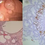 Fundic Gland Polyps