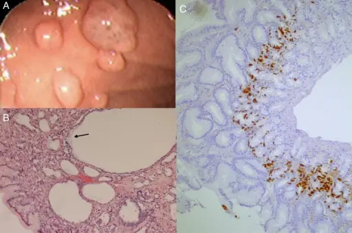 Fundic Gland Polyps