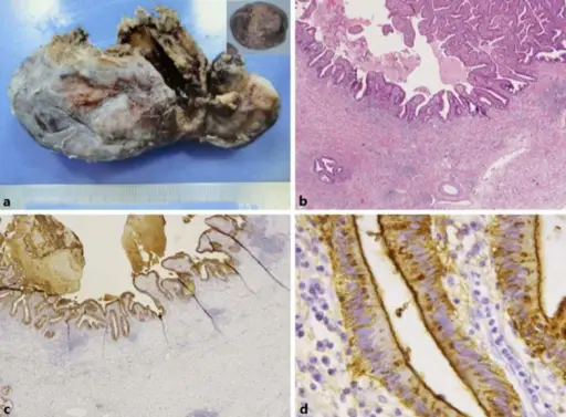 GALLBLADDER PATHOLOGY