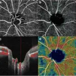 GLAUCOMATOUS OPTIC NERVE DAMAGE