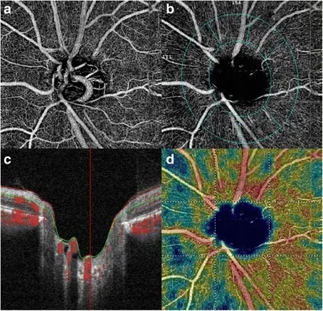 GLAUCOMATOUS OPTIC NERVE DAMAGE