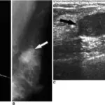 Galactorrhea