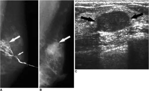 Galactorrhea