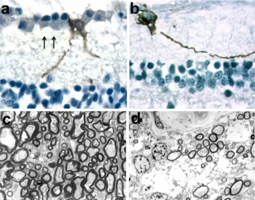 Ganglion Cysts