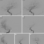 Gas Embolism