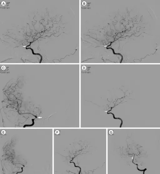 Gas Embolism