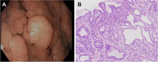 Gastric Adenoma