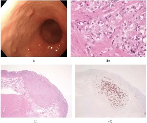 Gastric Carcinoid Tumor