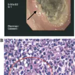 Gastric Lymphoma