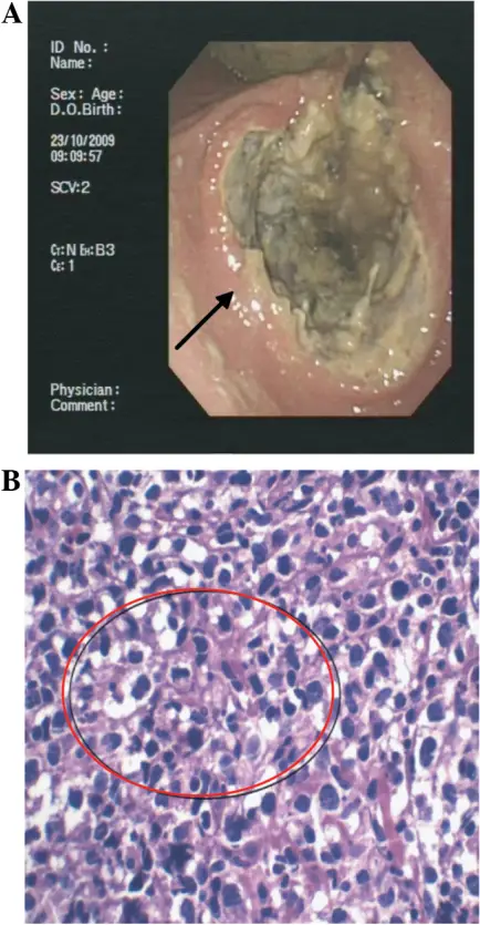 Gastric Lymphoma